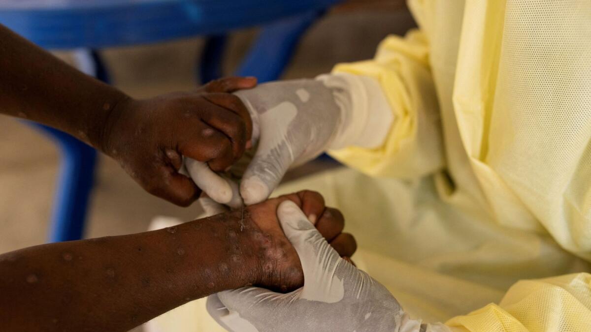 Mpox Sparks Debate Among WHO Experts Over Global Health Emergency Declaration